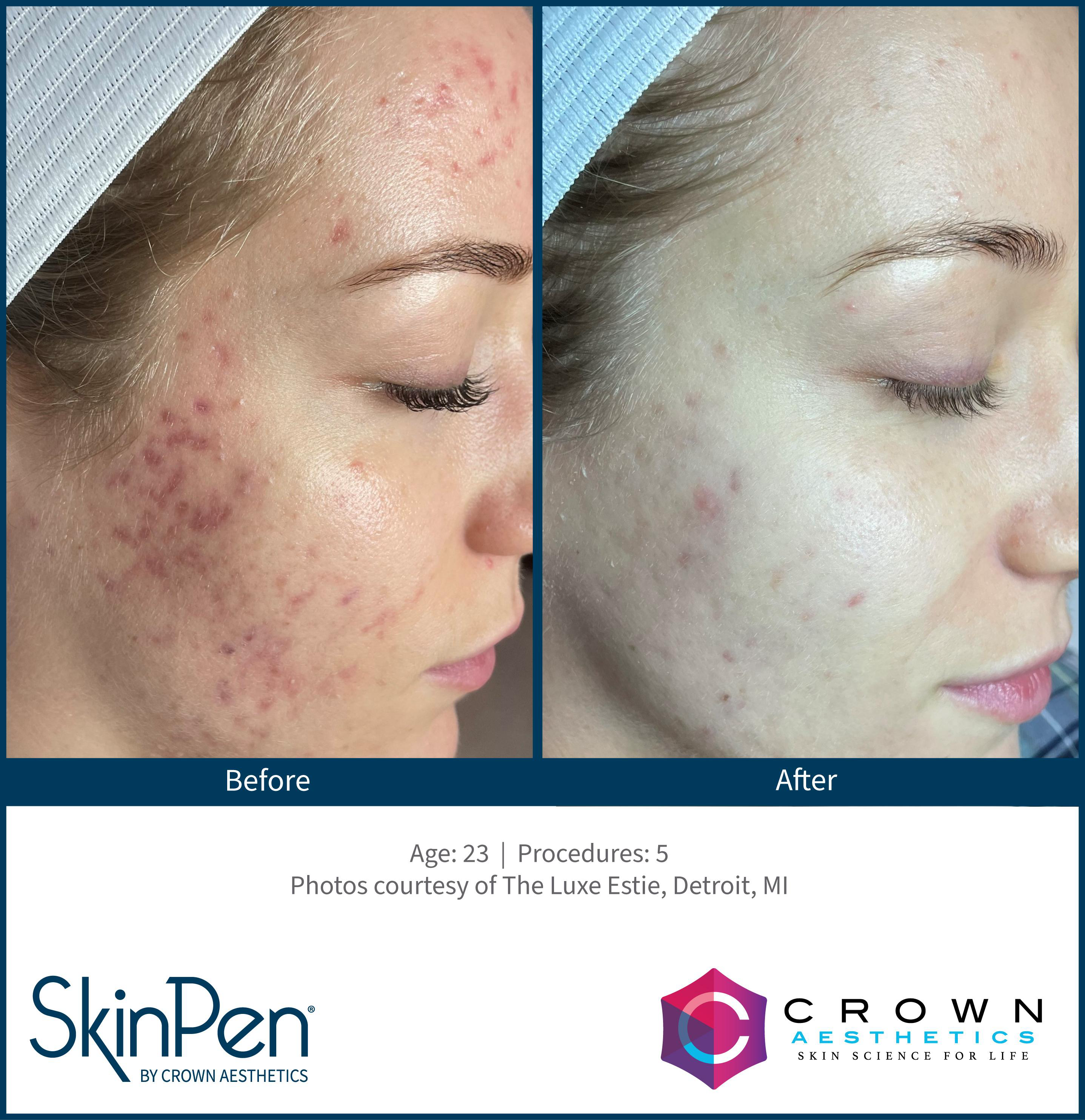 Stimulate collagen renewal with FDA-cleared microneedling.