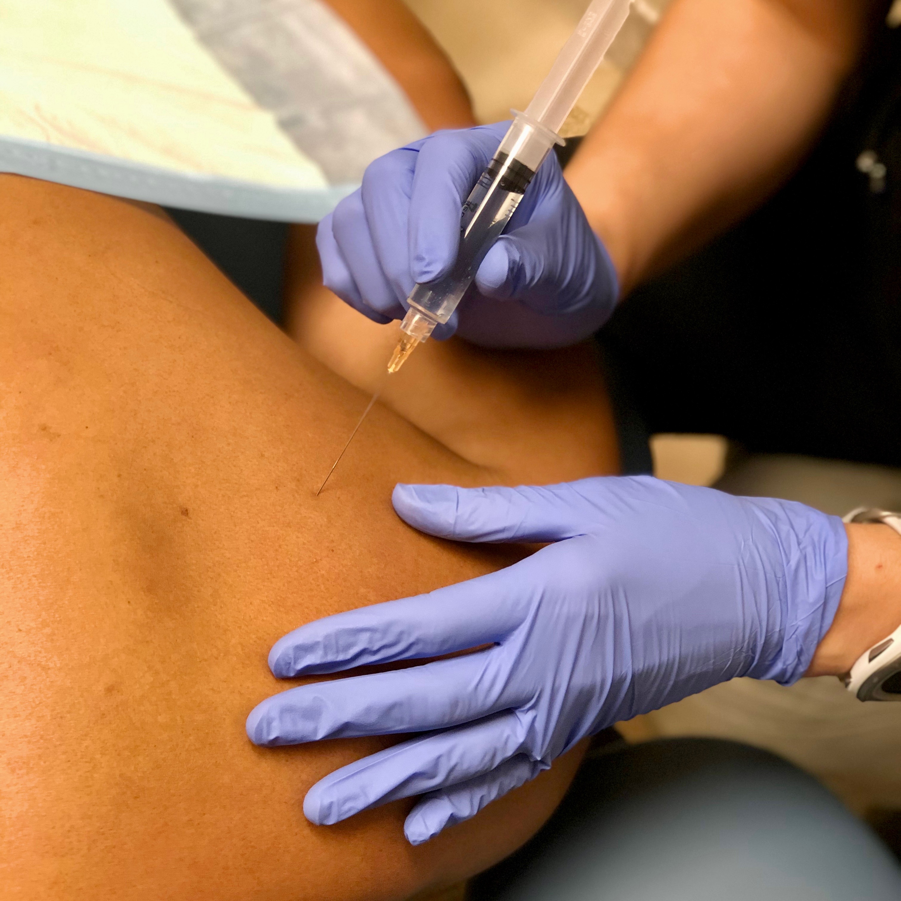 Trigger point injection being administered to a patient's upper back